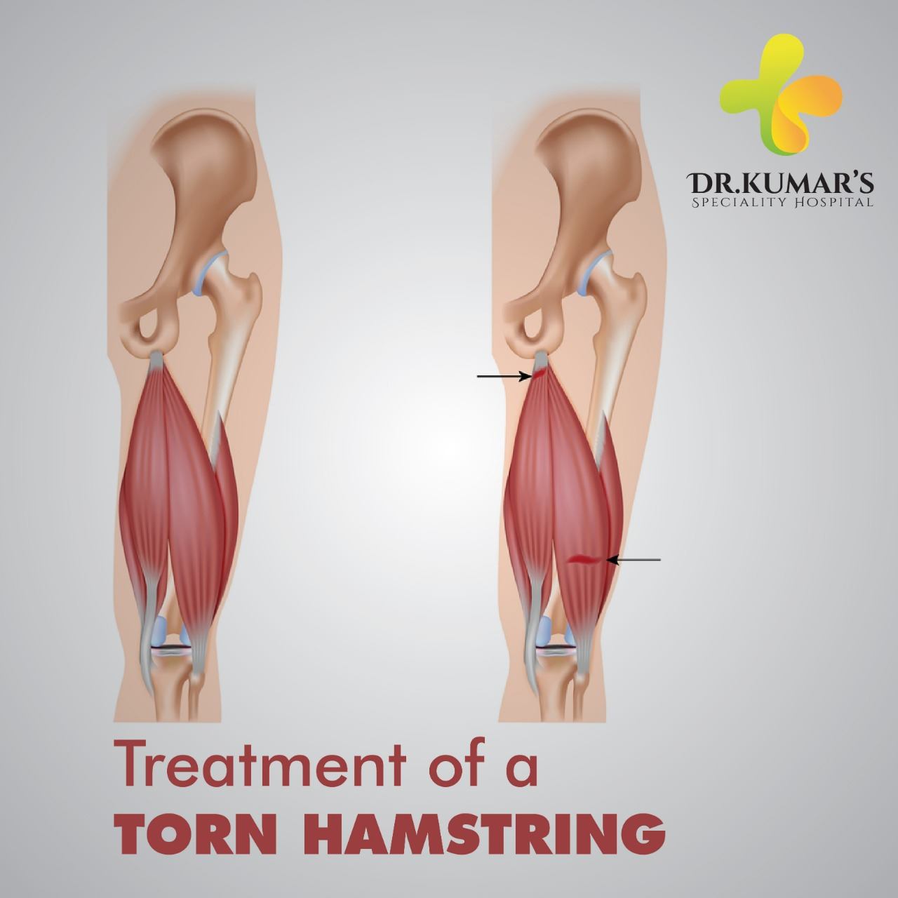 Hamstring Injury Information and Treatments