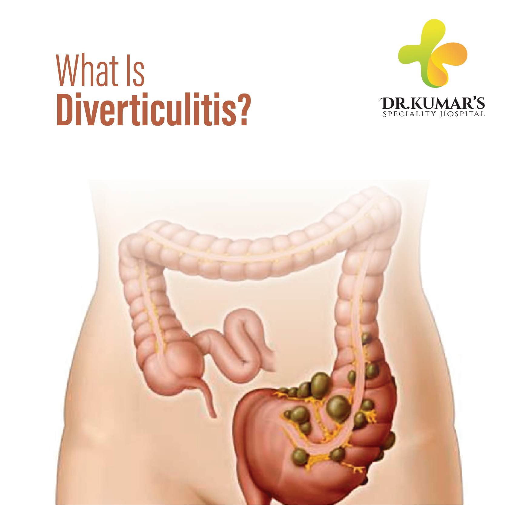 Diverticulitis: When to Go to the Hospital